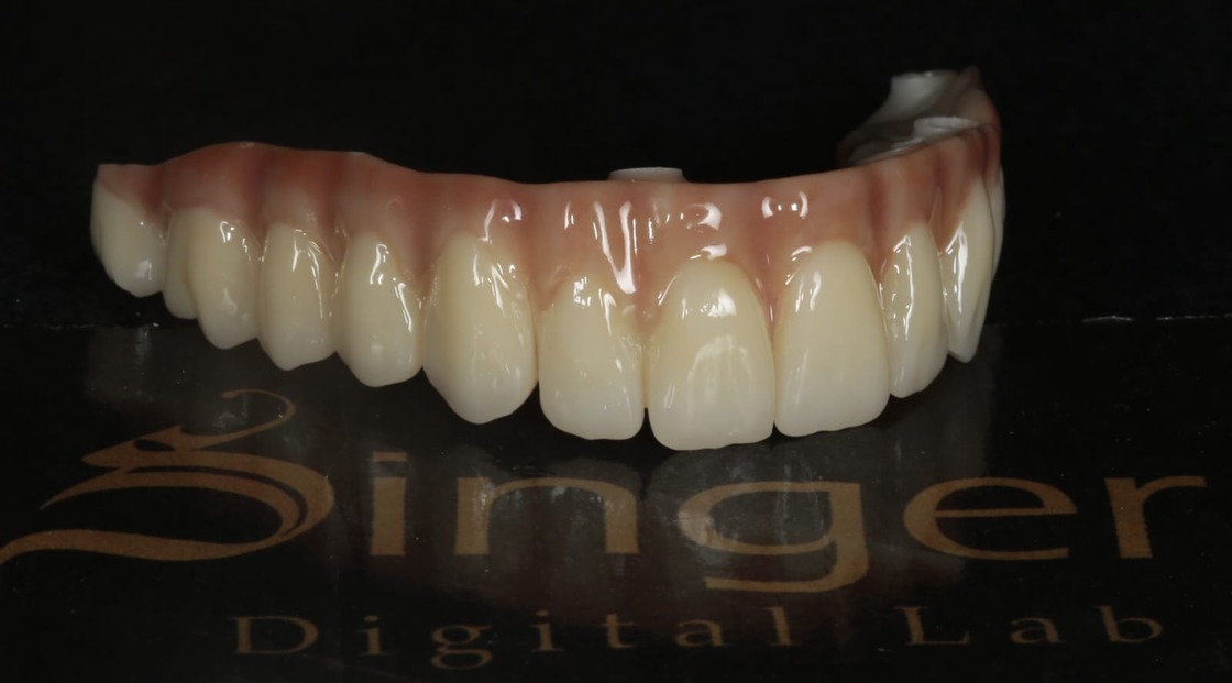 Yucera 4D Pro Dental - บล็อกเซรามิกเซอร์โคเนียเฉพาะทางพร้อมเทคโนโลยี HT Plus ช่วยเพิ่มคุณภาพของการบูรณะ