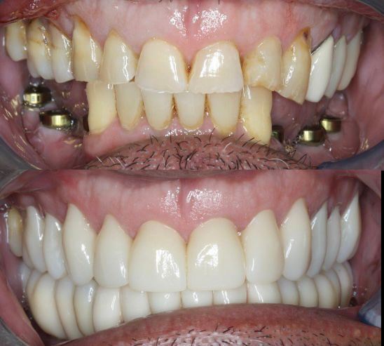 Yucera 4D Pro Dental - บล็อกเซรามิกเซอร์โคเนียเฉพาะทางพร้อมเทคโนโลยี HT Plus ช่วยเพิ่มคุณภาพของการบูรณะ